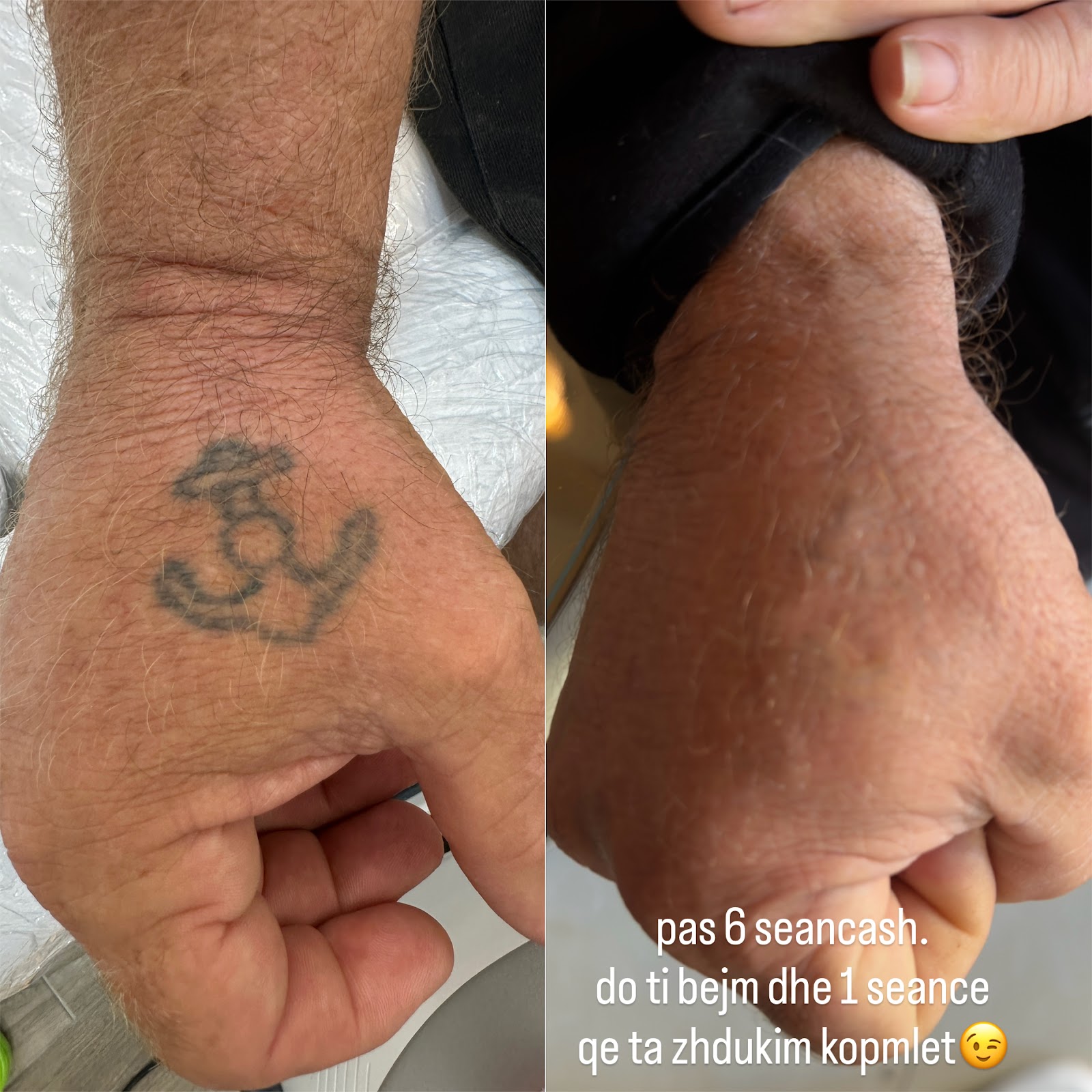 Removal Tattoo Fier