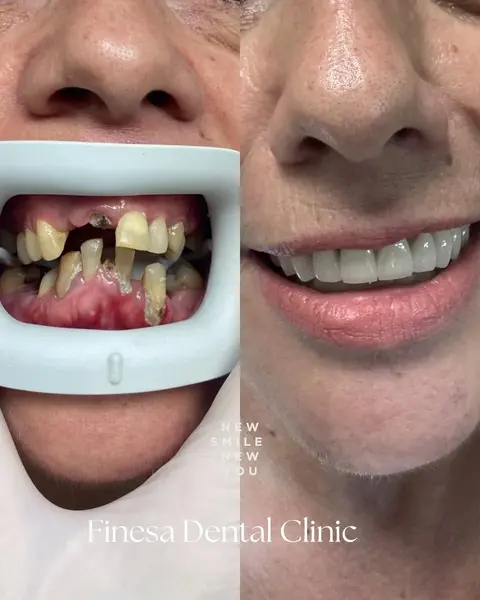 Finesa Dental Clinic | Dentisti in Albania | Aesthetic Dentist | Klinike Dentare ne Tirane